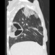 Lung abscess: CT - Computed tomography